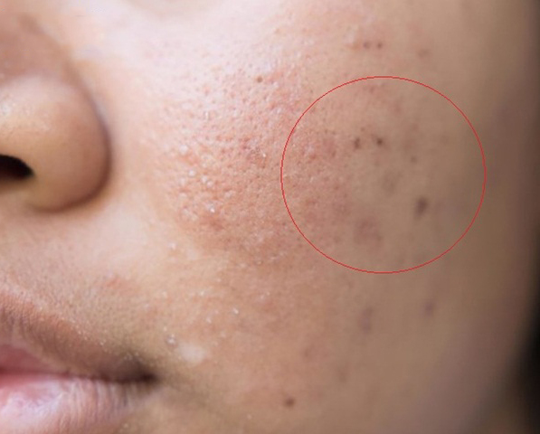 Trị Sẹo Thâm Tại Sen Beauty